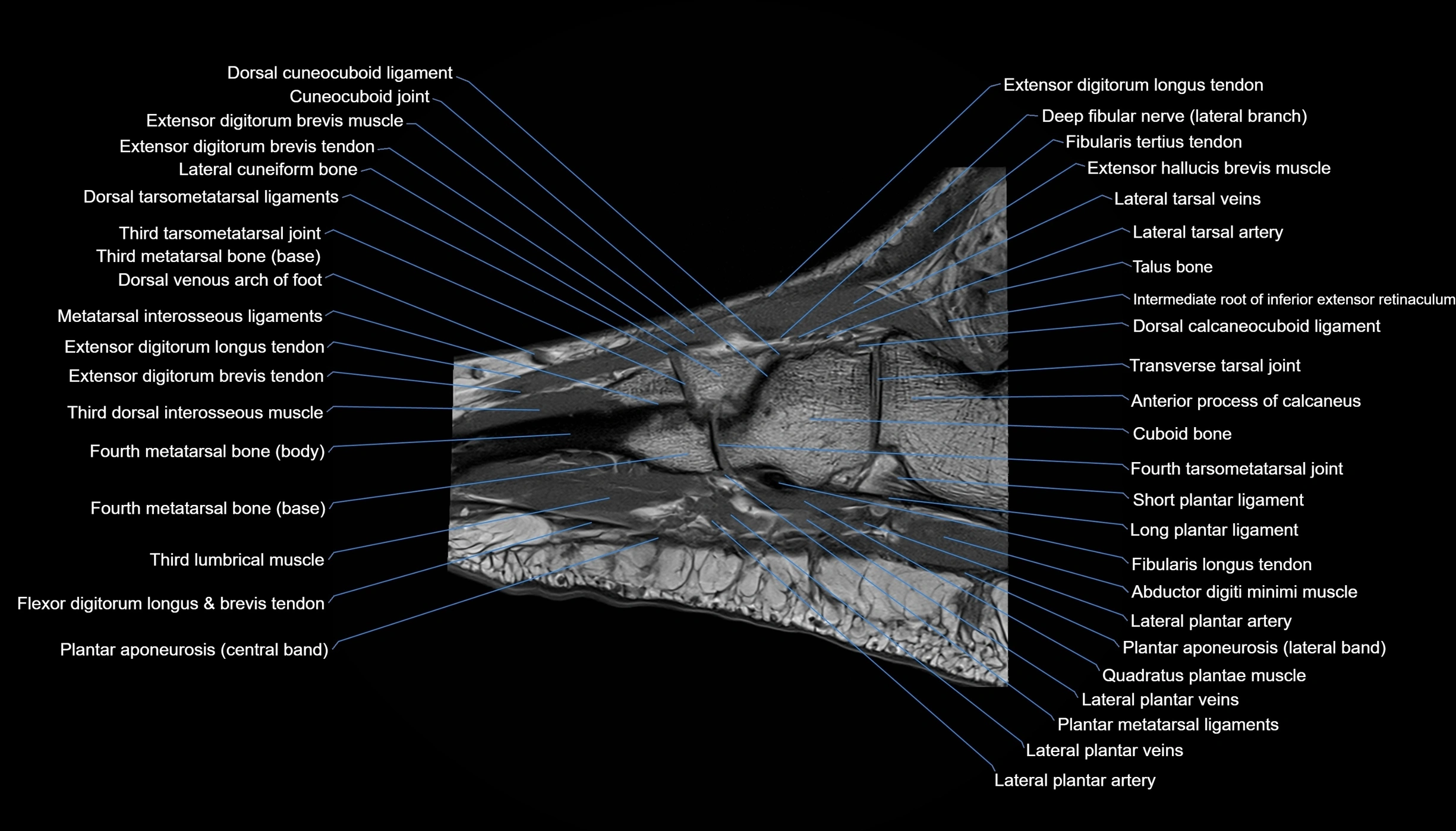 MRI mid foot sagittal cross sectional anatomy 3T  radiology  image-img-00001-00015.webp